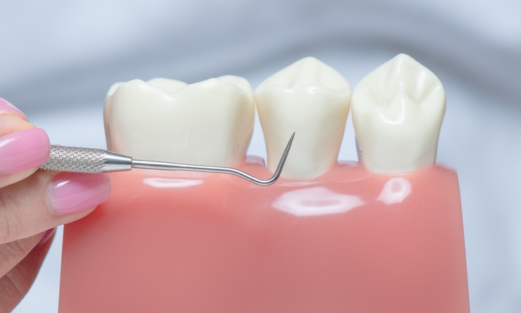 Czy można zakładać licówki na krzywe zęby? Czy można zakładać licówki na krzywe zęby?