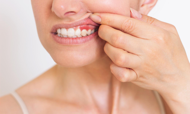 Krwawienie z dziąseł – przyczyny, leczenie i profilaktyka